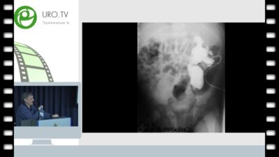 Бондаренко С.Г. - Лапароскопические операции в детской урологии в сложных случаях