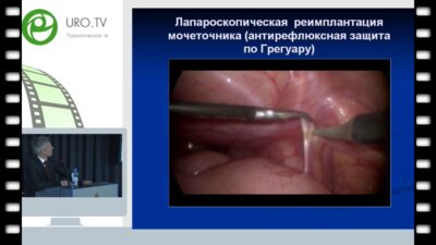 Рудин Ю.Э. - Наш первый опыт лапароскопической и пневмовезикоскопической реимплантации мочеточника при обструктивном мегауретере у детей