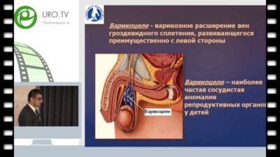 Тарзян А.О. - Изучение состояния гематотестикулярного барьера у подростков с варикоцеле