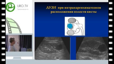 Врублевская Е.Н. - Диагностика и тактика лечения детей с кортикальными кистозными поражениями почек