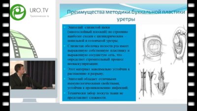 Титов Д.В. - Реконструктивные операции на мочеиспускательном канале у детей с использованием лоскута из слизистой щеки