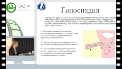 Стрижова Д.Н. - Клинический случай удвоения полового члена у ребенка с проксимальной формой гипоспадии