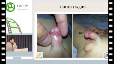 Акрамов Н.Р. - Осложнения операции на крайней плоти