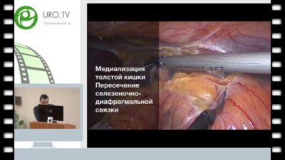 Лапароскопическая нефрэктомия при поликистозной болезни почек