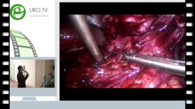 Богомолов С.А. - Лапароскопическая резекция почки с гигантской опухолью