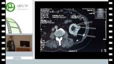 Гусейнов Р.Г. - Наш опыт лапароскопической резекции множественных образований единственной левой почки
