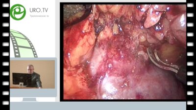 Антонов А.В. - Лапароскопическая резекция левой почки