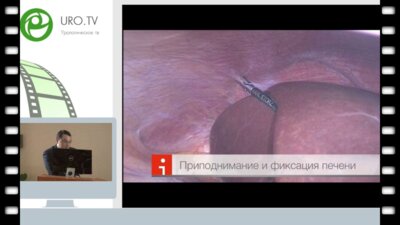 Опыт выполнения лапароскопической нефрэктомии у родственного донора почки