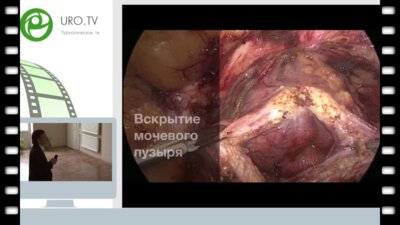 Лапароскопическая аденомэктомия