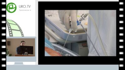 Орлов И.Н. - Операция микроперкутанная нефролитотрипсия под УЗИ контролем