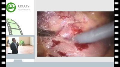 Ракул С.А. - Робот-ассистированная нефрэктомия с тромбэктомией