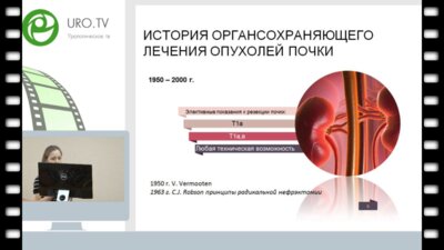 Лушина П.А. - Лапароскопическая резекция почки без ишемии и без наложения гемостатического шва на зону резекции у пациентов с раком почки