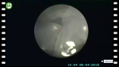 Стандартная перкутанная нефролитолапаксия справа