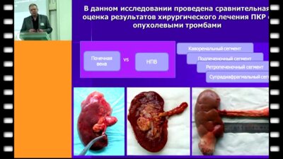 Лесовой В.Н. - Результаты хирургического лечения почечно-клеточного рака с внутривенозным распространением
