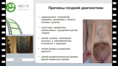 Носов А.К. - Оценка влияния комбинированного лечения на фертильность пациентов герминогенными опухолями яичка