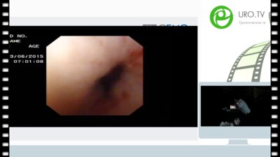 Мазуренко Д.А. - Гибкая нефроскопия