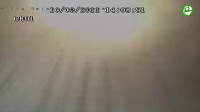 Лапароскопическая резекция почки