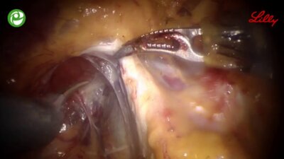 Робот-ассистированная радикальная простатэктомия