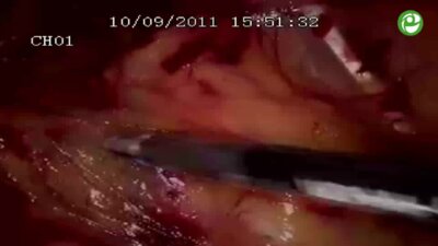 Лапароскопическая пластика мочеточника по Боари