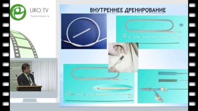 Феофилов И.В. - Дренирование почек