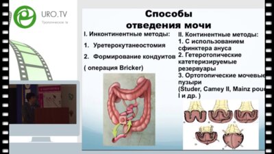Забелин М.В., Погосян Р.Р. Варианты илеоцисто-пластики при раке мочевого пузыря