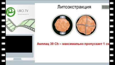 Григорьев Н.А. - Литоэкстрация во время перкутанной хирургии. Что нового?