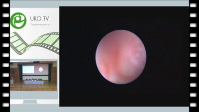 Ергаков Д.В. - Инновации в перкутанной хирургии