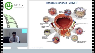 Образовательная лекция д.м.н., проф. Цуканова А.Ю. «Важность персонифицированного подхода к пациенту в терапии ДГПЖ»