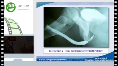 Г.Барбали - Реконструкция мужской уретры (часть 2)