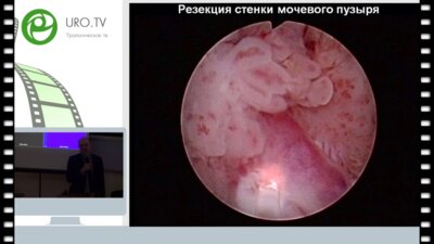 Бурлака О.О. - Неклассическое использование гольмиевого лазера