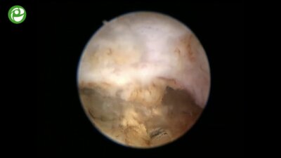 Секция живой хирургии: Энуклеация гиперплазии простаты.