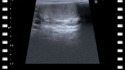 Капто А.А., Габлия М.Ю. Варикоз вен простаты при варикоцеле.