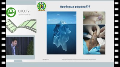 Агзамходжаев С.Т. - Использование влагалищной оболочки яичка при хирургическом лечении послеоперационных осложненений гипоспадии у детей