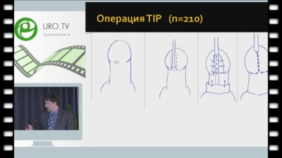 Жарков Д.А. - Результаты хирургического лечения дистальной формы гипоспадии
