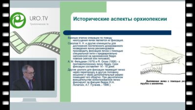 Кравцов Ю.А. - Способ низведения яичек при крипторхизме