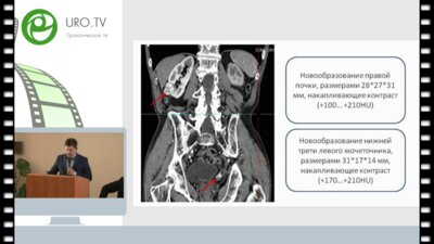 Обидняк В.М. - Лапароскопическая резекция опухоли правой почки, резекция нижней трети левого мочеточника с формированием неоуретероцисто- анастомоза при раке правой почки с метастатическим поражением контрлатерального мочеточника