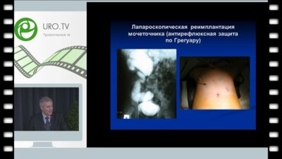 Рудин Ю.Э. - Лапароскопическая реимплантация мочеточника у детей с мегауретером