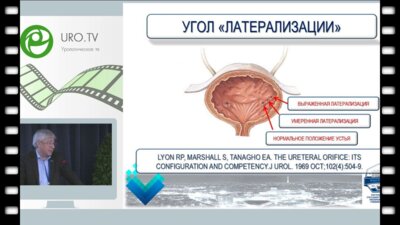 Сизонов В.В. - Латерализация устья мочеточника при везикоуретеральном рефлюксе - миф или реальность?