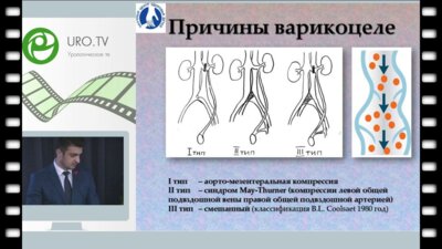Тарзян А.О. - Оценка маркеров поражения гематотестикулярного барьера у подростков с варикоцеле