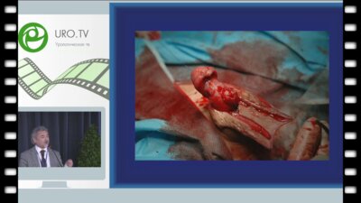 Файзулин А.К. - Варианты хирургического лечения детей с осложненными формами гипоспадии