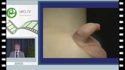 Файзулин А.К. - Хордома полового члена