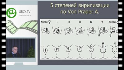 Шибеко Е.В. - Опыт феминизирующих операций при нарушении полового развития у девочек