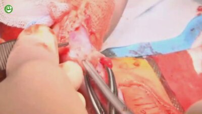 Одномоментная пластика уретры (onlay-tube-onlay)