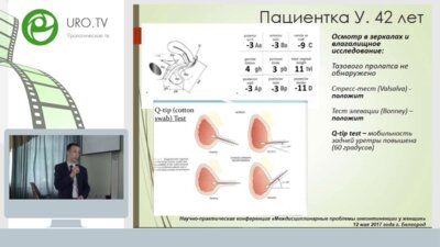 Обтураторный слинг синтетической петлей при стрессовой инконтиненции