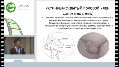 Тохтаев М.К. - Скрытый половой член у детей