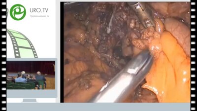 Гулиев Б.Г. - Лапароскопическая тотальная кишечная пластика левого мочеточника