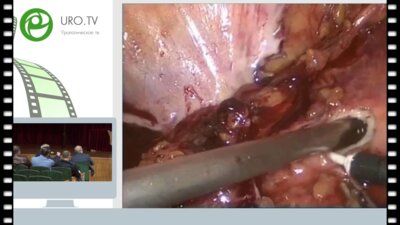 Гулиев Б.Г. - Лапароскопический уретероцистоанастомоз по Боари