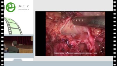 Шпоть Е.В. - Лапароскопическая лоскутная пластика протяженной стриктуры верхней трети левого мочеточника
