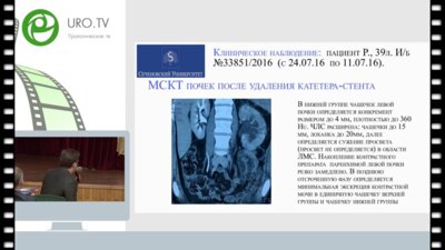 Шпоть Е.В. - Пластика мочеточника тубуляризированным фрагментом толстой кишки