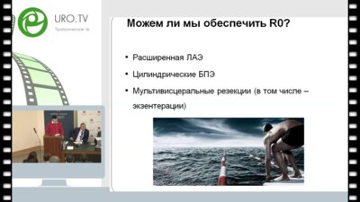 Мошуров М.И. - Опыт 100 экзентераций малого таза по поводу первичного и рецидивного рака прямой кишки
